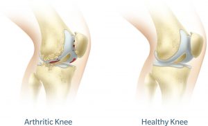 Side by side comparison of arthritic knee and healthy knee